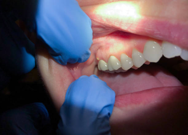 Best Emergency Dental Care for Abscessed Tooth in Winterville, NC